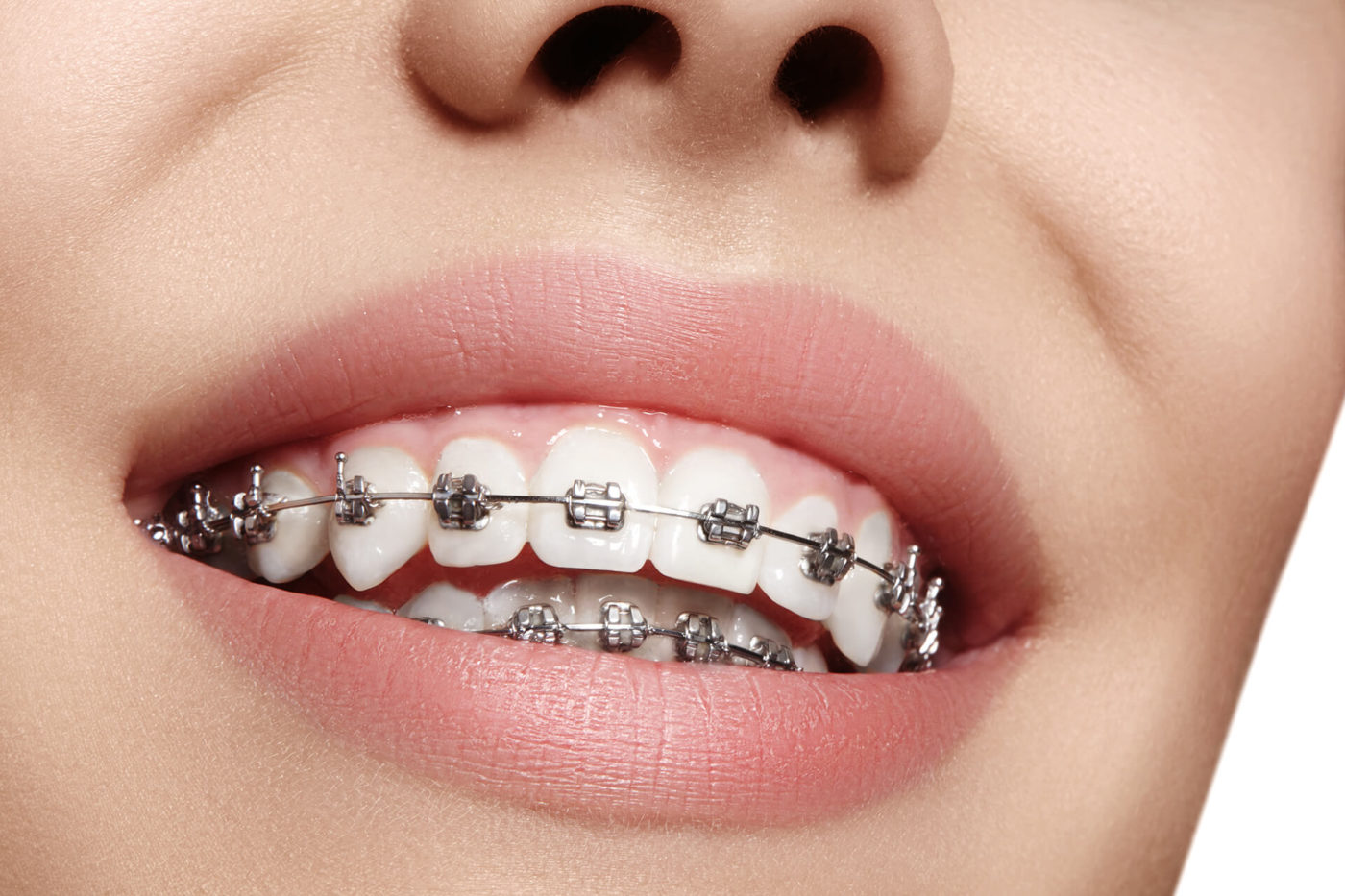 ¿Cómo se colocan los brackets de un ‘aparato’ dental? – Vélez & Lozano