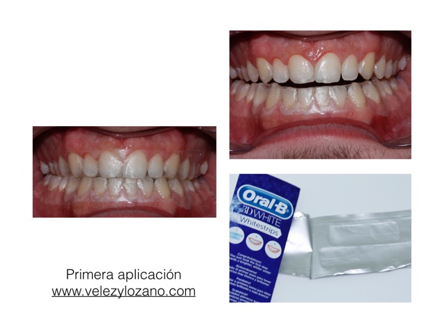 Blanqueamiento Con Oral-B 3D Whitestrips En Murcia – Vélez & Lozano