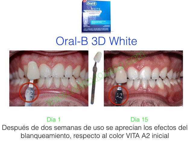 Blanqueamiento Con Oral-B 3D Whitestrips En Murcia – Vélez & Lozano