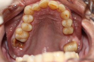 Una filtración ha supuesto que el diente tenga una caries y la corona se desprenda (abajo a la izquierda)