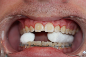Una vez retirados, lo habitual es que queden restos del cemento empleado para pegarlos a los dientes durante el tratamiento, que debemos eliminar