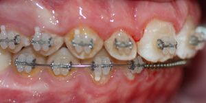 La relación entre las dos arcadas es correcta, y los dientes están alineados para conseguir función y estética