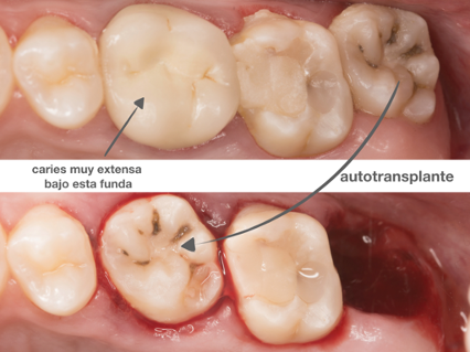 Costoso alguna cosa ventajoso Tipos de Transplante Dental - Vélez & Lozano
