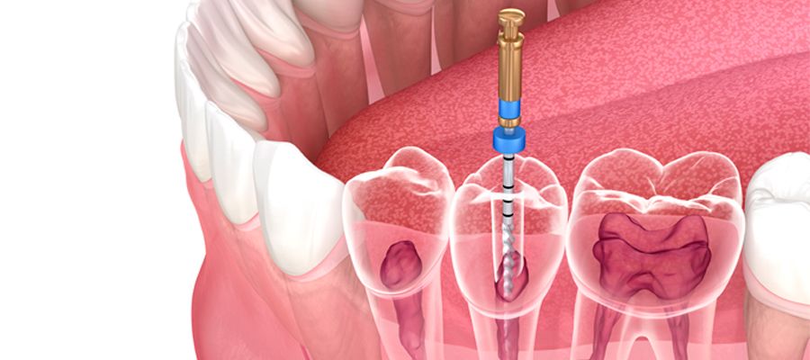 Las claves de una buena endodoncia