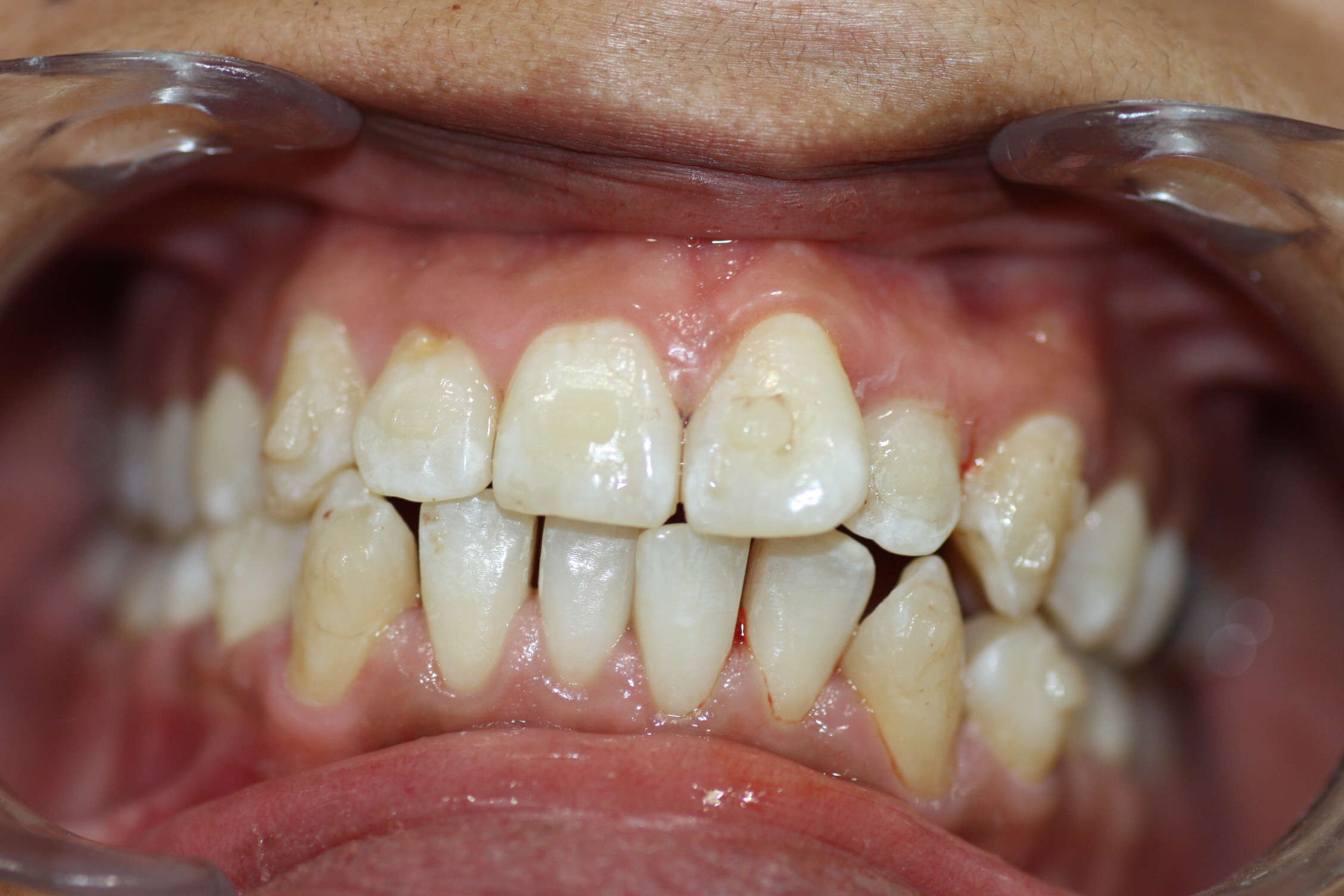 Why are patients with 'braces' having their teeth 'filed down