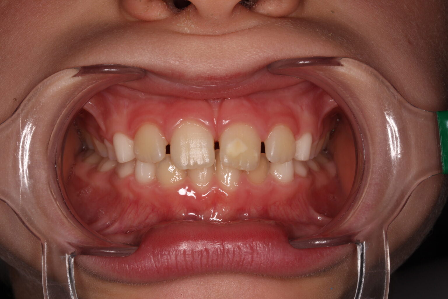 Qué es la Hipomineralización Incisivo Molar (MIH) Vélez & Lozano