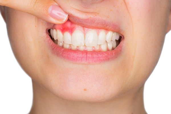 ¿Cómo se cura la periodontitis?