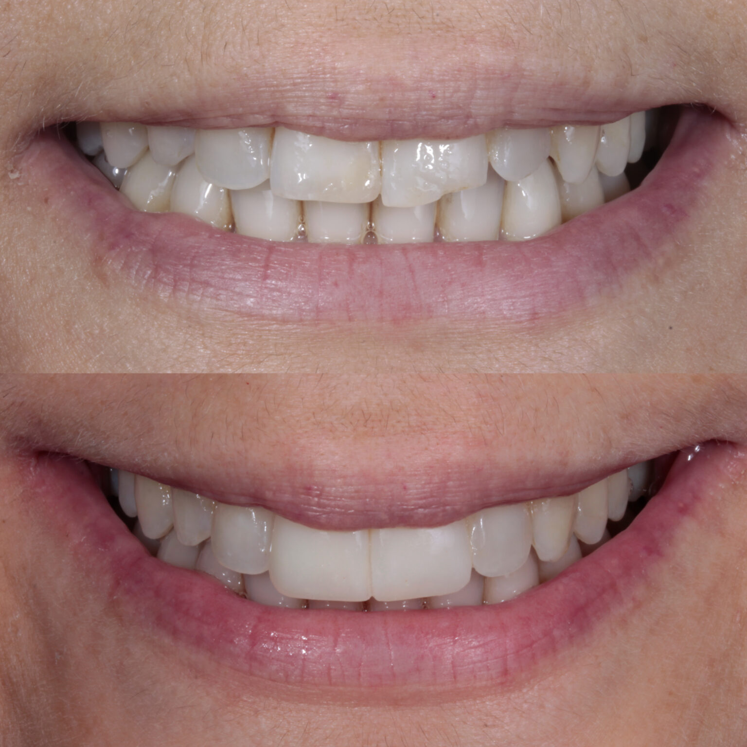 Composite qué es y para qué se usa en odontología Vélez & Lozano