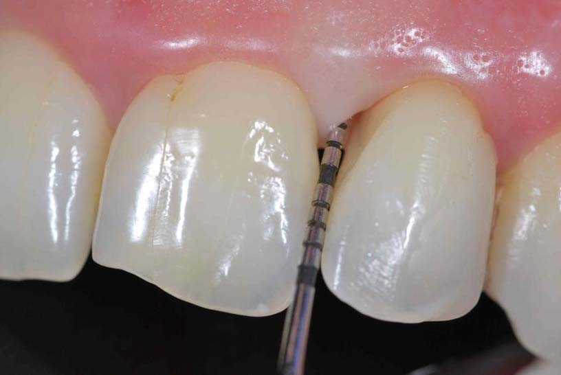 La periodontitis tiene cura ✅